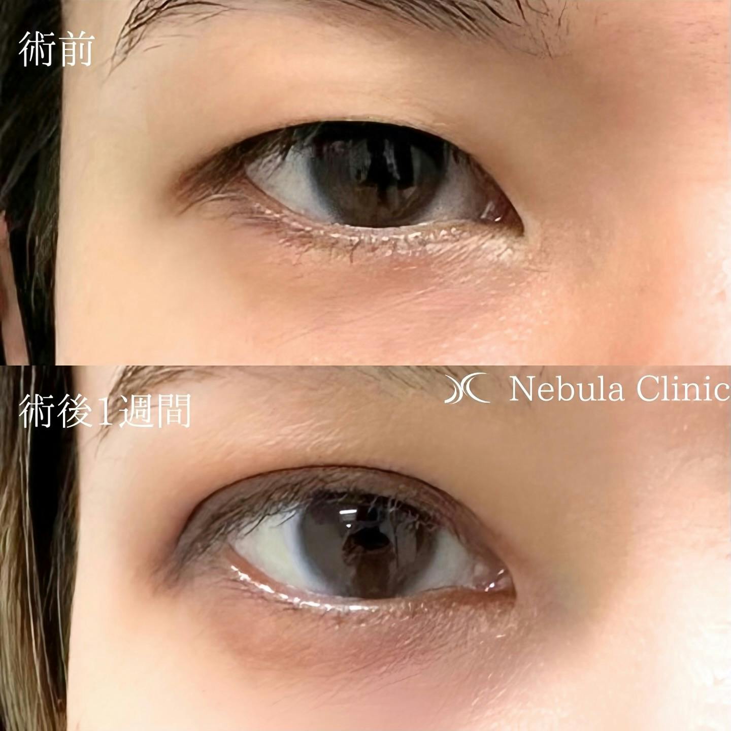 【女性・目元】二重埋没法_before_aftar