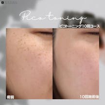 【女性・シミ】ピコトーニング_before_aftar