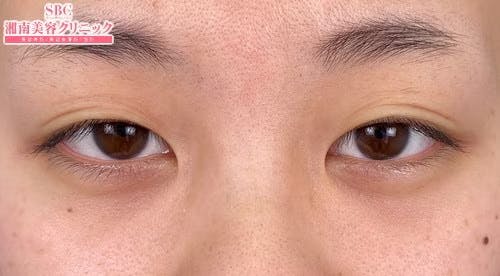 【女性・目元】線留めクロス二重術_before