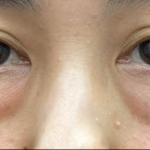 【女性・目元】目の下の切らないクマ・たるみ(ふくらみ)取り、ナチュラル脂肪注射コンデンスリッチ、ナチュラル脂肪注射ナノリッチ_before