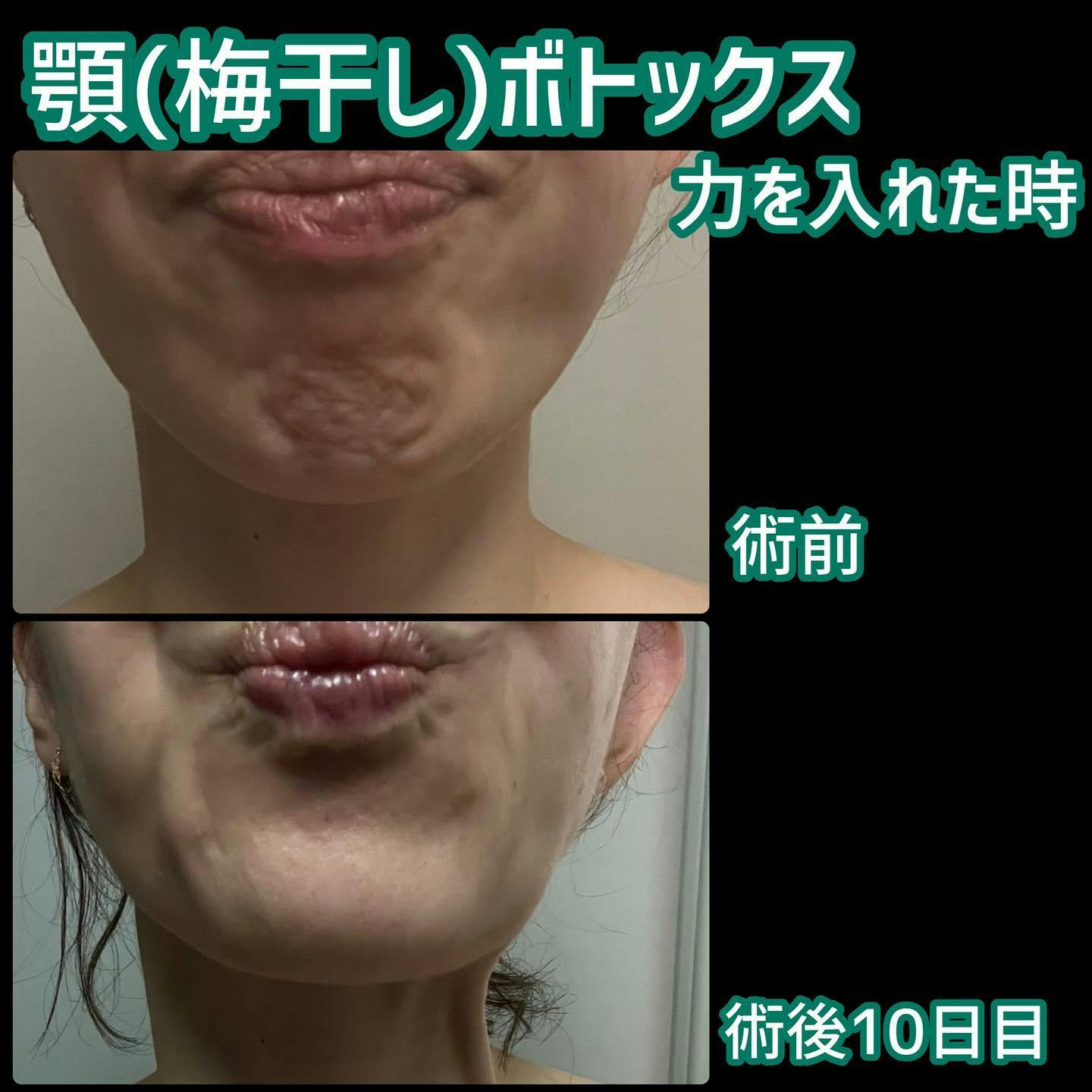 【女性・シワ】顎（梅干し）ボトックス_before_aftar