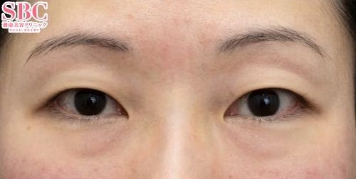 【30代女性・目元】裏ハムラ法、VOV（ボブ）リフト_before