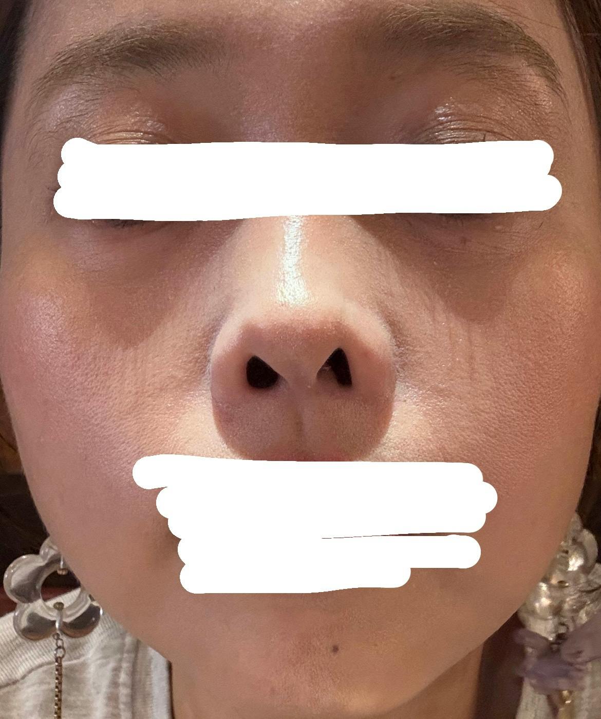 エースクリニック名古屋院/アネックス院でを受けたねむ子さんの写真