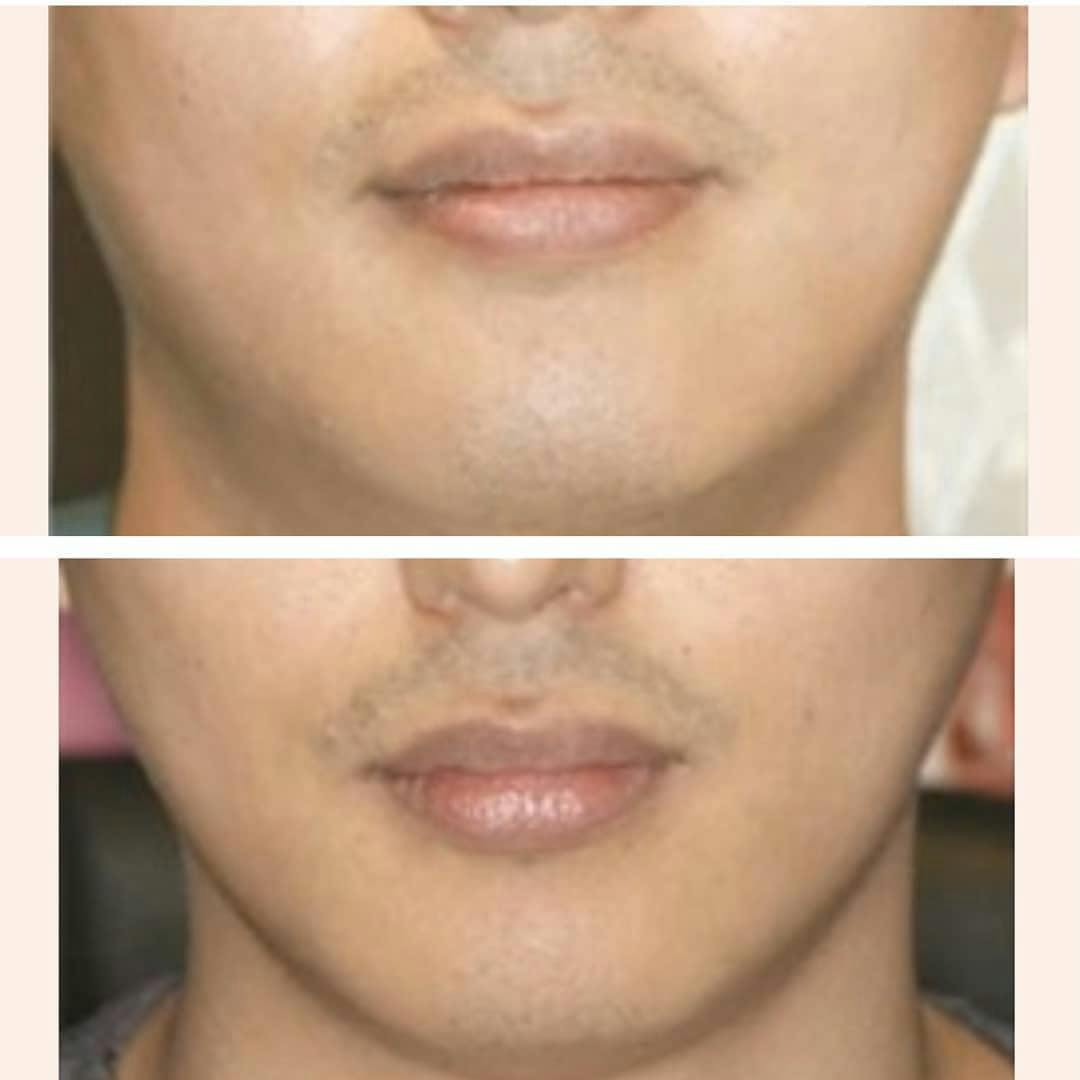 【男性・輪郭】小顔注射・スリミング注射_before_aftar