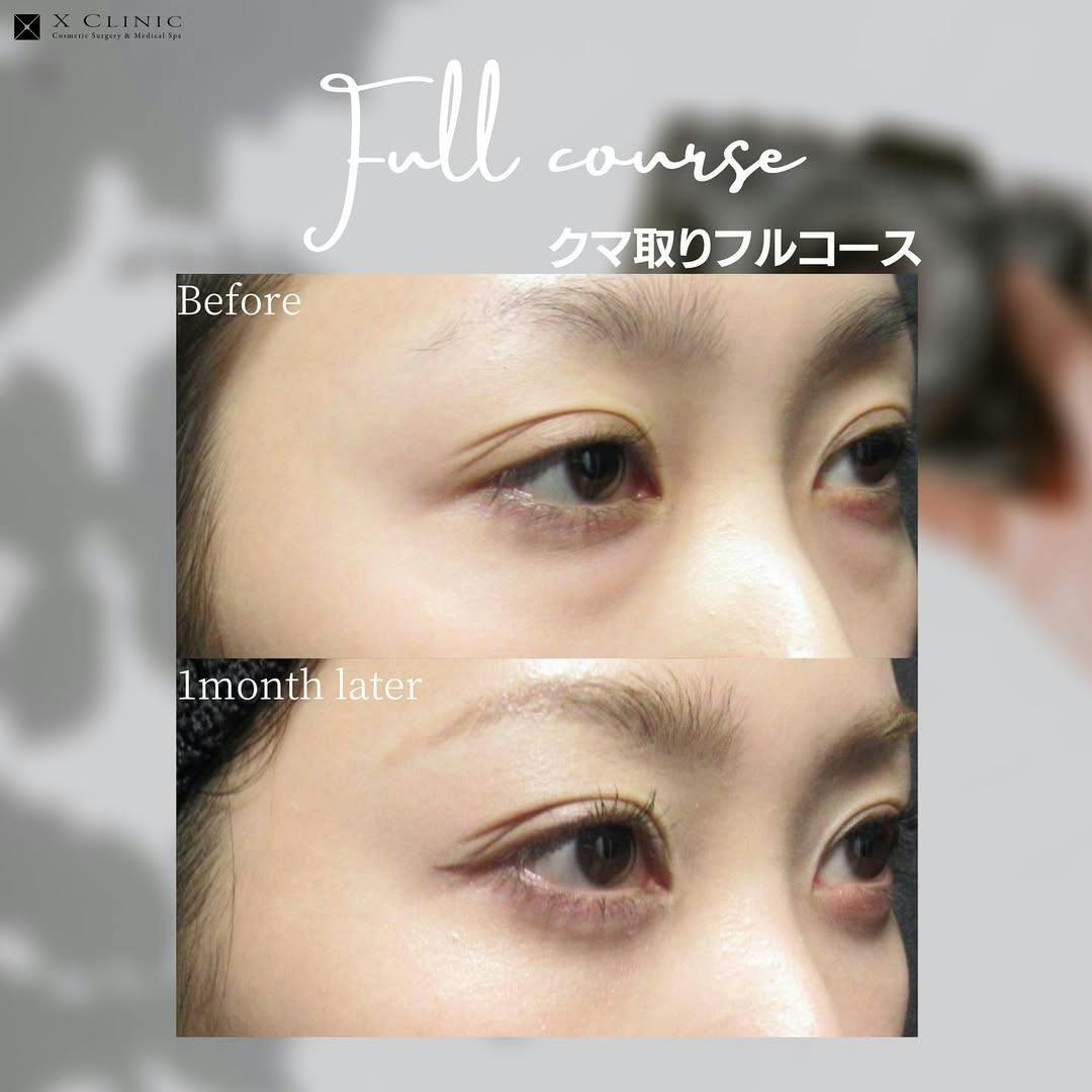 【女性・クマ】クマ取りフルコース_before_aftar