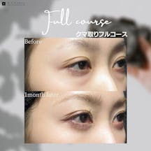 【女性・クマ】クマ取りフルコース_before_aftar