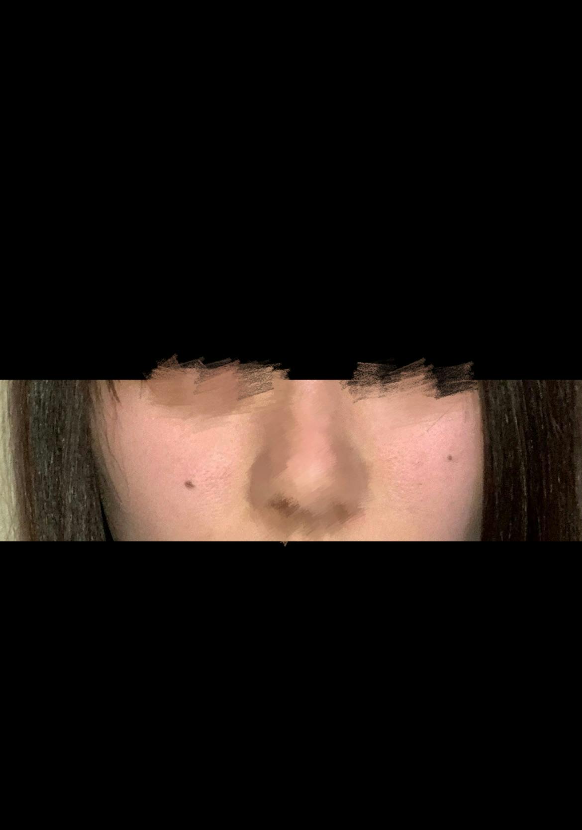 渡辺皮膚科・形成外科クリニックで炭酸ガスレーザーを受けたやむさんの写真