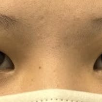 【女性・目元】線留めクロス二重術、フォーエバー二重術_before