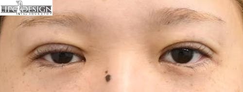 【33歳女性・目元】グランドループ法_justafter