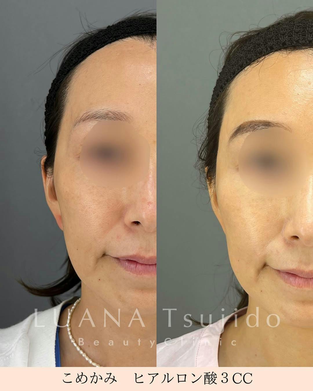 【女性・こめかみ】ヒアルロン酸_before_aftar