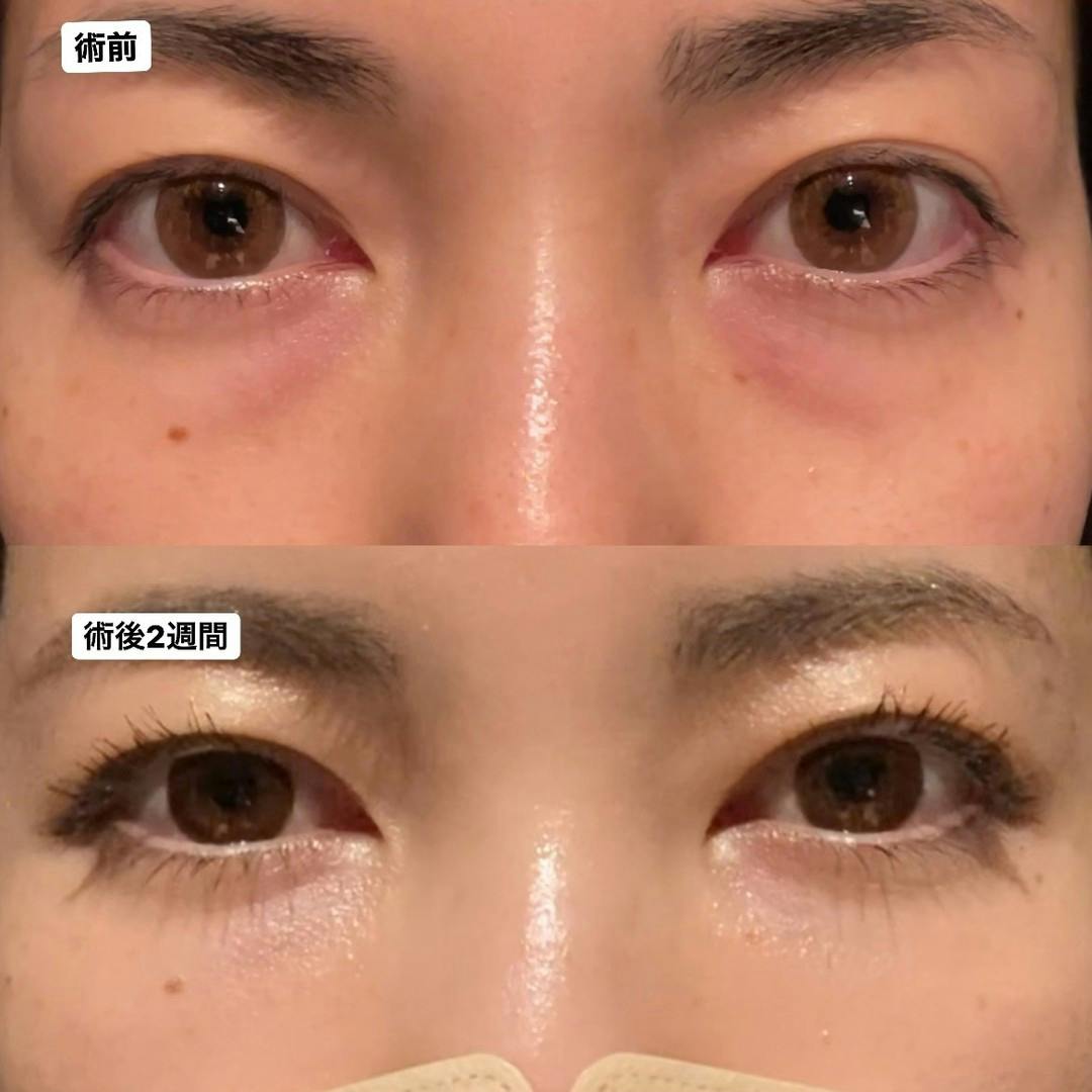 【女性・目元】くまとりフルコース＋コンデンスリッチファット注入_before_aftar
