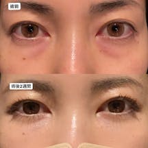 【女性・目元】くまとりフルコース+コンデンスリッチファット注入_before_aftar