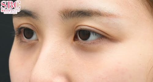 【20代女性・目元】目の下の切らないクマ・たるみ（ふくらみ）取り、ナチュラル脂肪注射コンデンスリッチ、ナチュラル脂肪注射ナノリッチ_after