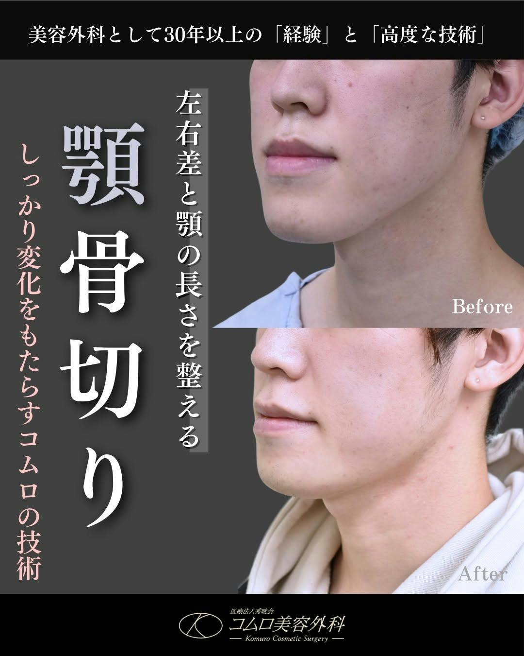 【20代男性・顎】顎骨切り_before_aftar