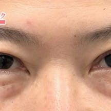 タルミ取り併用全切開法二重、眼瞼下垂 _after