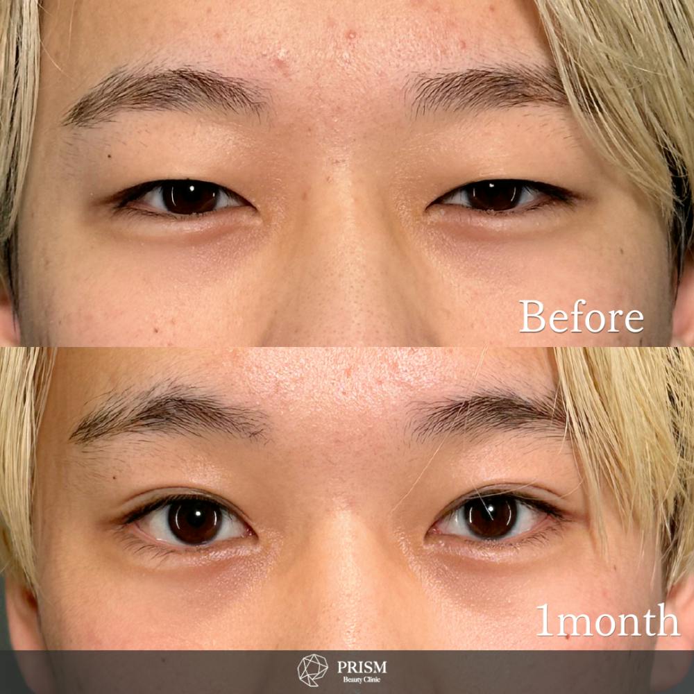 【10代男性・目】PRISM 1day二重埋没 プレミアム 線留め (自然癒着法)_before_aftar