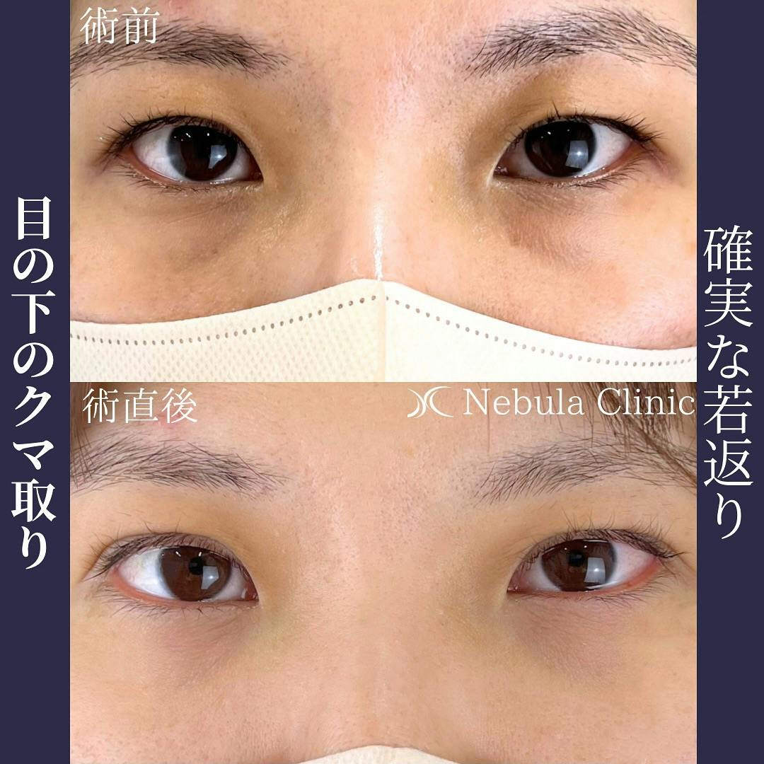 【女性・クマ】切らない目の下のクマ取り・たるみ取り_before_aftar