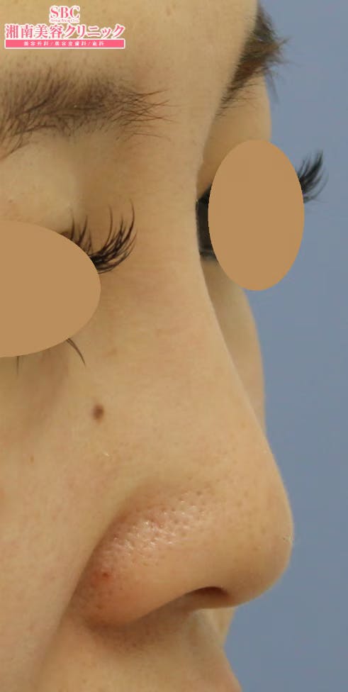 【女性・鼻】SBCプレミアムソフトプロテーゼ_aftar