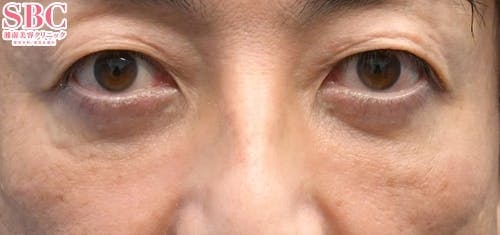 【目元】目の下の切らないクマ・たるみ（ふくらみ）取り、ナチュラル脂肪注射コンデンスリッチ、ナチュラル脂肪注射ナノリッチ_aftar