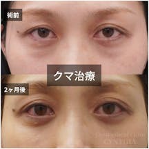 【40代女性・目元】目の下のクマ取り_before_aftar