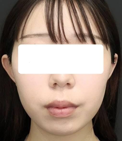 品川スキンクリニック福岡院でフェイスアップ＋脂肪溶解：脂肪溶解注射＋スレッドリフト（エラ）を受けたちゃみさんの写真
