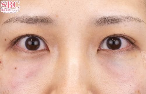 【20代女性・目元】目の下の切らないクマ・たるみ（ふくらみ）取り、ナチュラル脂肪注射コンデンスリッチ、ナチュラル脂肪注射ナノリッチ_justafter