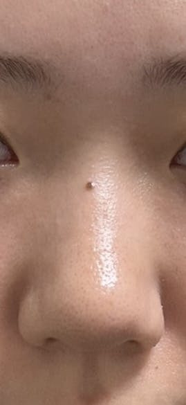 湘南美容クリニック 大阪梅田本院で医療痩身・ダイエット・脂肪溶解注射・BNLS注射を受けたnaagiiさんの写真