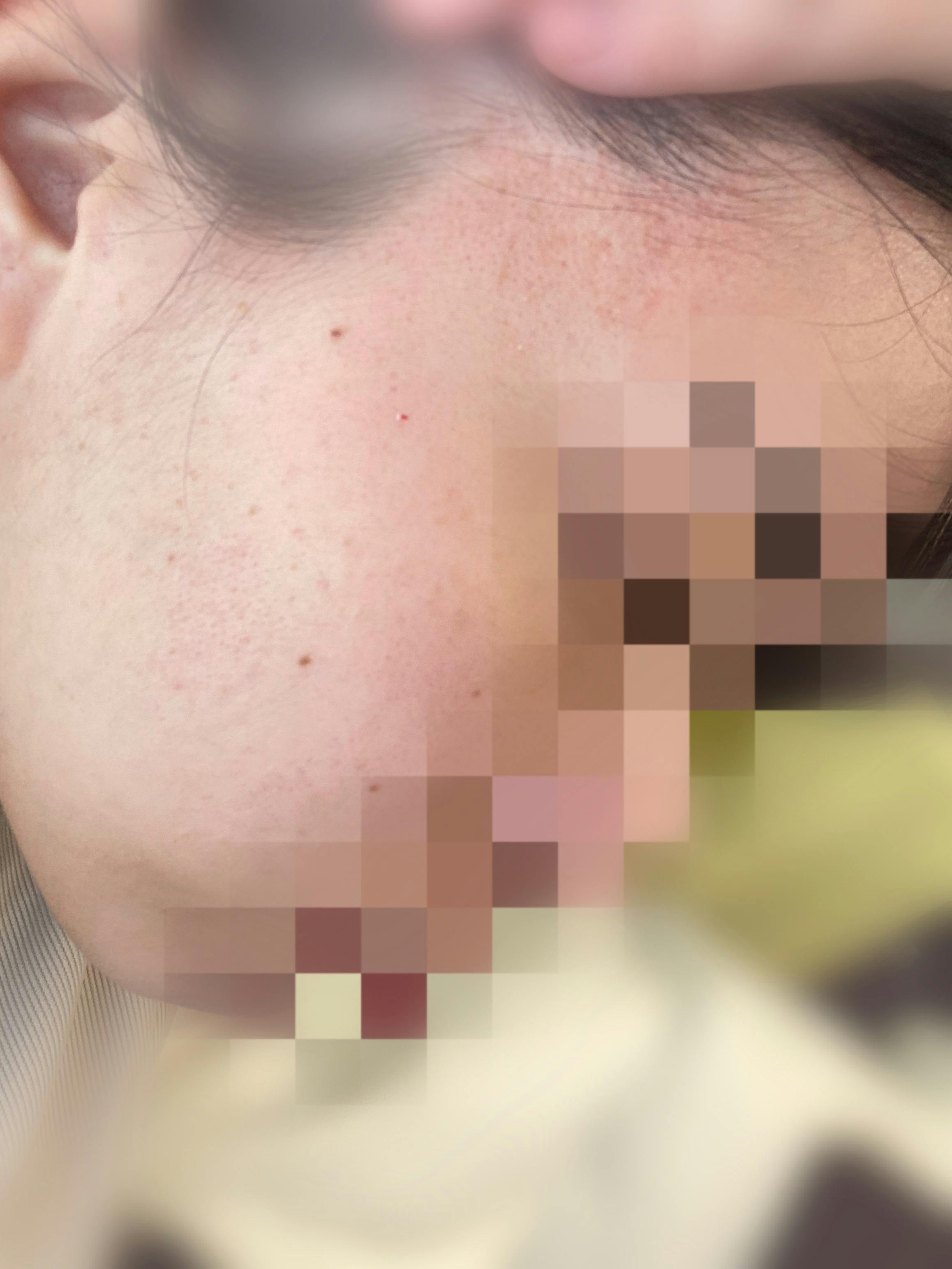 Jスキンクリニック(JSKINクリニック)でほくろ・いぼ除去を受けたなるとよさんの写真
