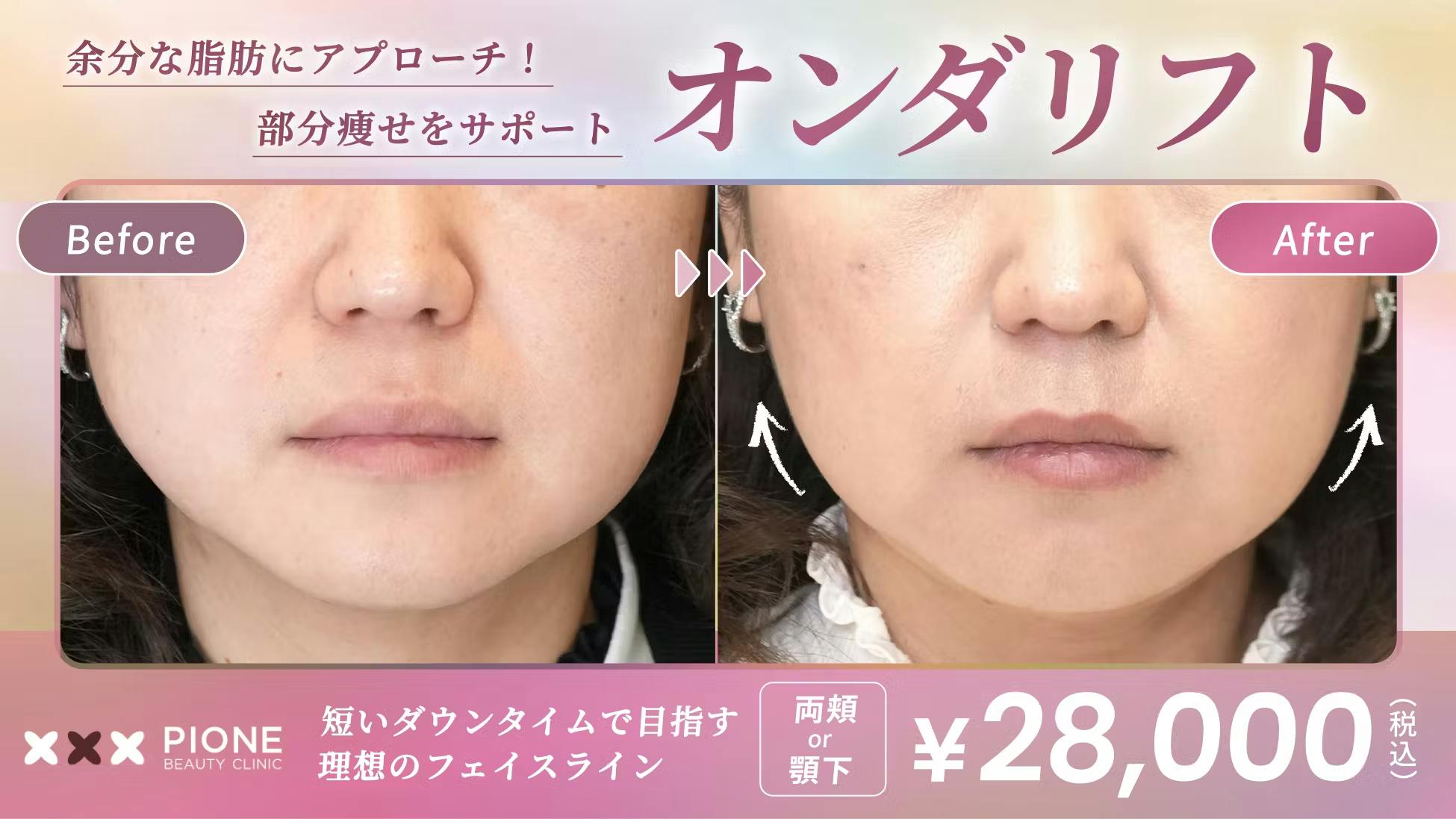 ピオーネビューティクリニック(PIONE BEAUTY CLINIC)のサムネイル画像