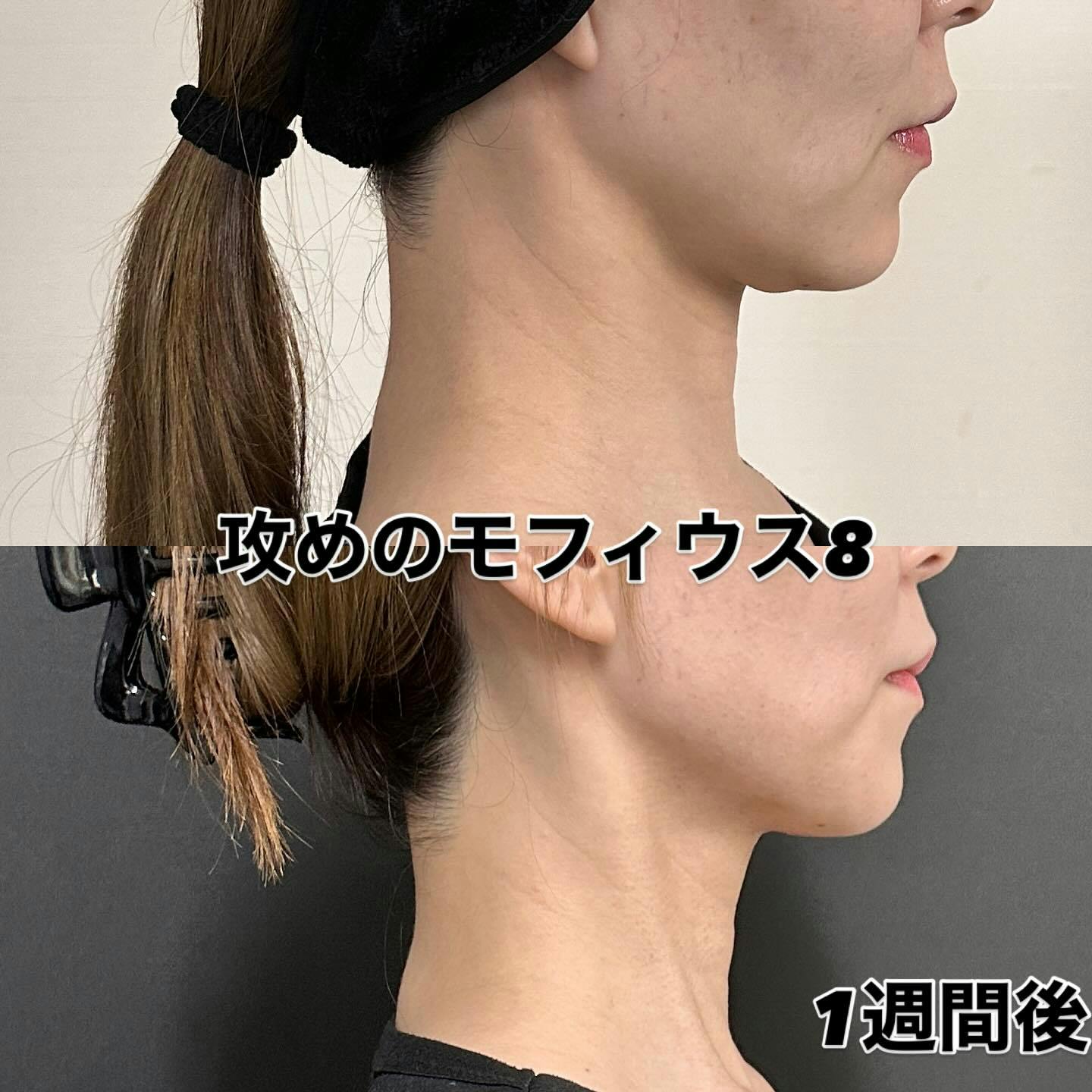 【女性・顔】攻め”のモフィウス8_before_aftar