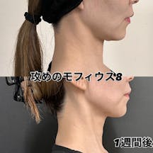 【女性・顔】攻め”のモフィウス8_before_aftar