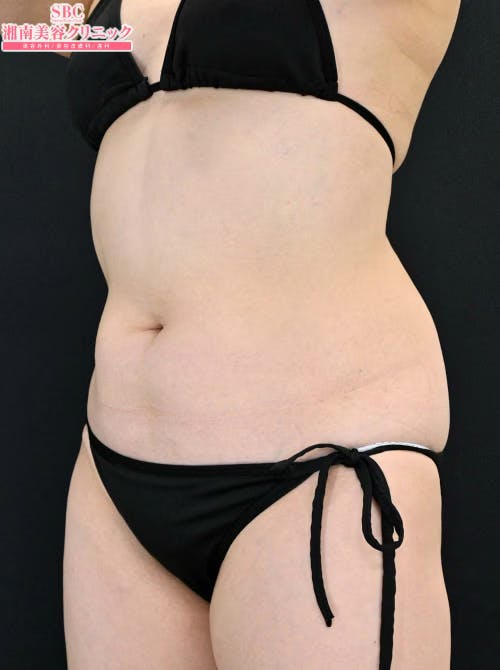 【50代女性・腹部】ダイエット注射 MITI（マイティ）_after