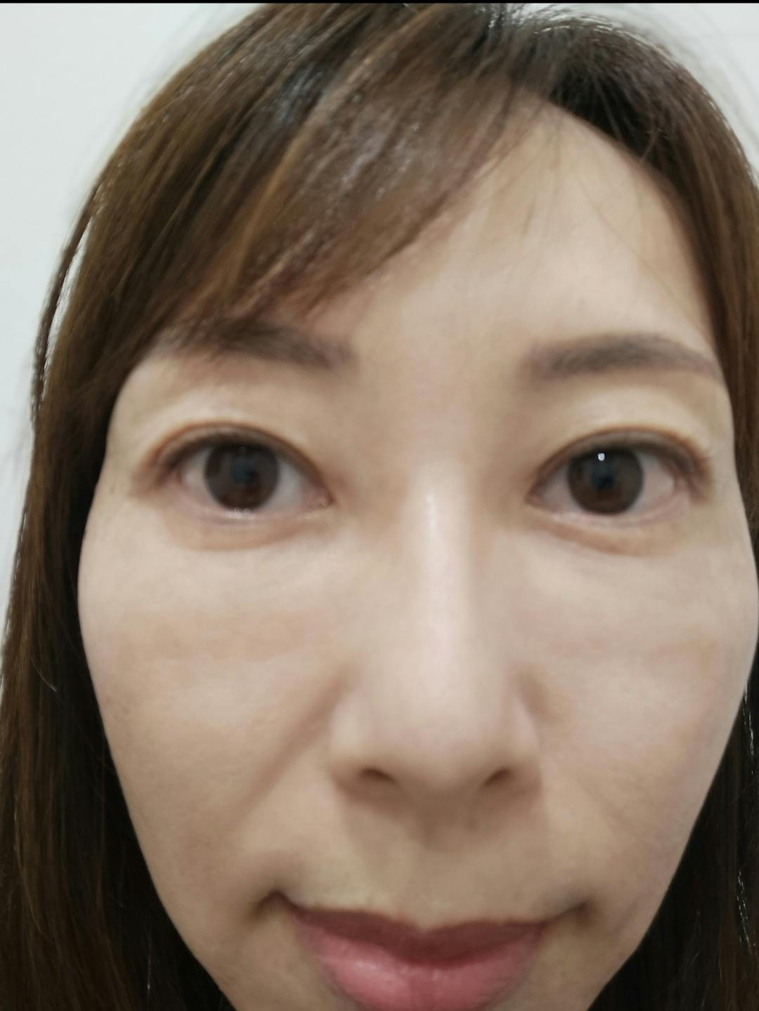 湘南美容クリニック 長野院で女優注射を受けたりょうさんの写真