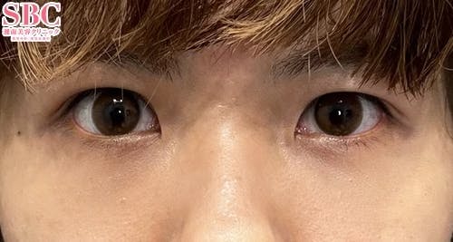 【20代女性・クマ】裏ハムラ法_aftar