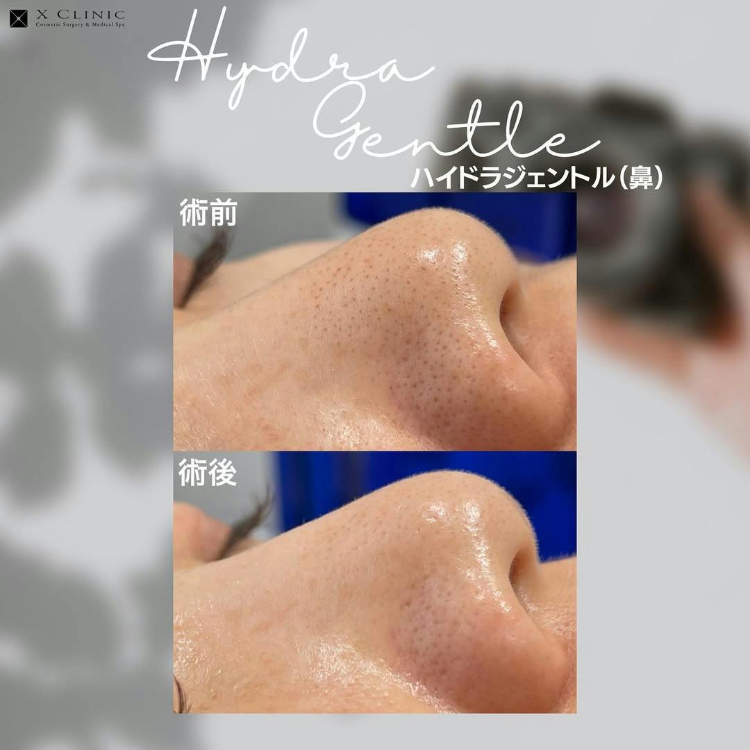 【毛穴】ハイドラジェントル_before_aftar