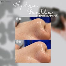 【毛穴】ハイドラジェントル_before_aftar