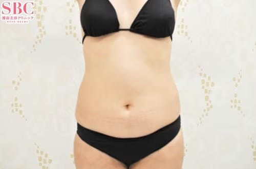 【女性・腹部】根こそぎVASER脂肪吸引、ライポマティック脂肪吸引、Aquicell（アキーセル）脂肪吸引_before