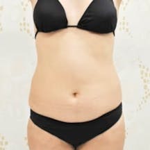 【女性・腹部】根こそぎVASER脂肪吸引、ライポマティック脂肪吸引、Aquicell(アキーセル)脂肪吸引_before