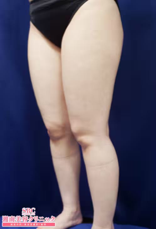 【女性・脚】美ボディ脂肪吸引、根こそぎVASER脂肪吸引、Aquicell（アキーセル）脂肪吸引_before