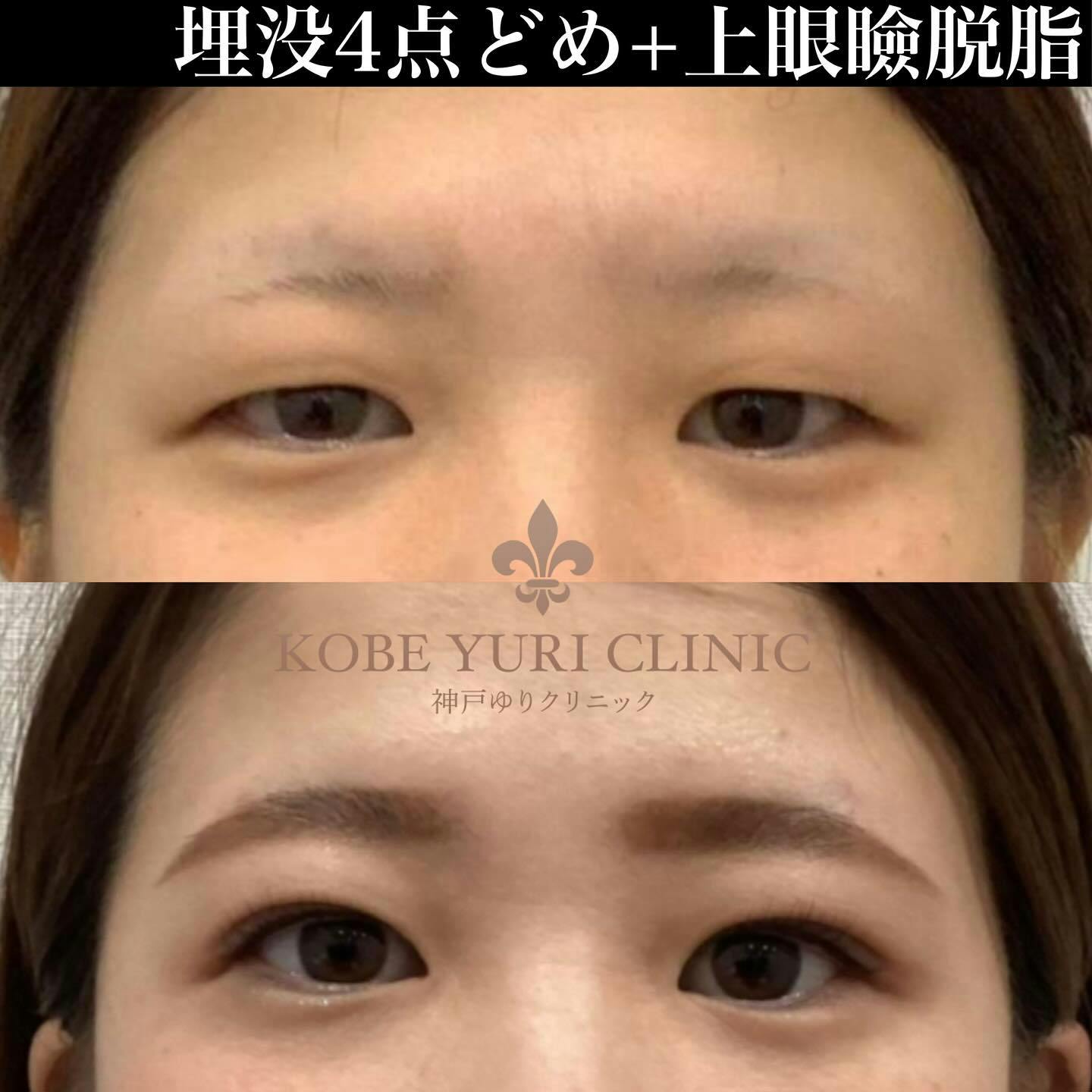 【女性・目元】二重埋没法 2点留め＋上眼瞼脱脂_before_aftar