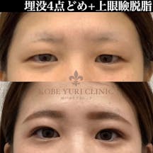 【女性・目元】二重埋没法 2点留め+上眼瞼脱脂_before_aftar