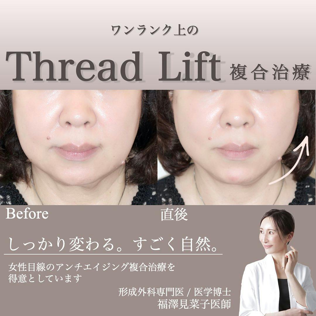 【女性・輪郭】糸リフト_before_aftar