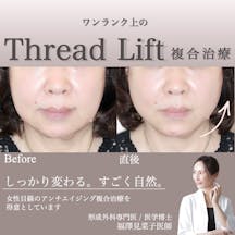 【女性・輪郭】糸リフト_before_aftar