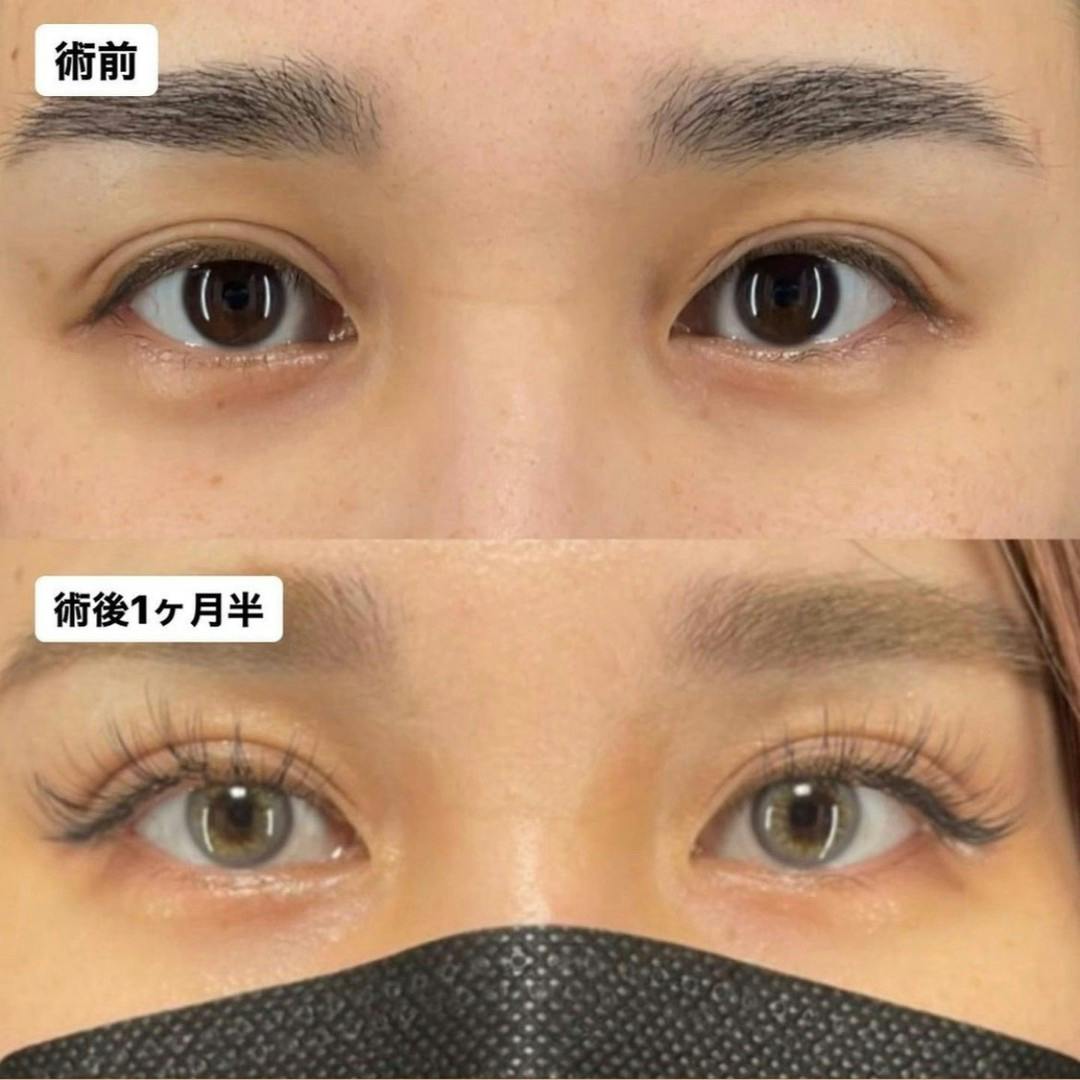 【女性・目元】Xクロスダブル_before_aftar