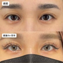 【女性・目元】Xクロスダブル_before_aftar