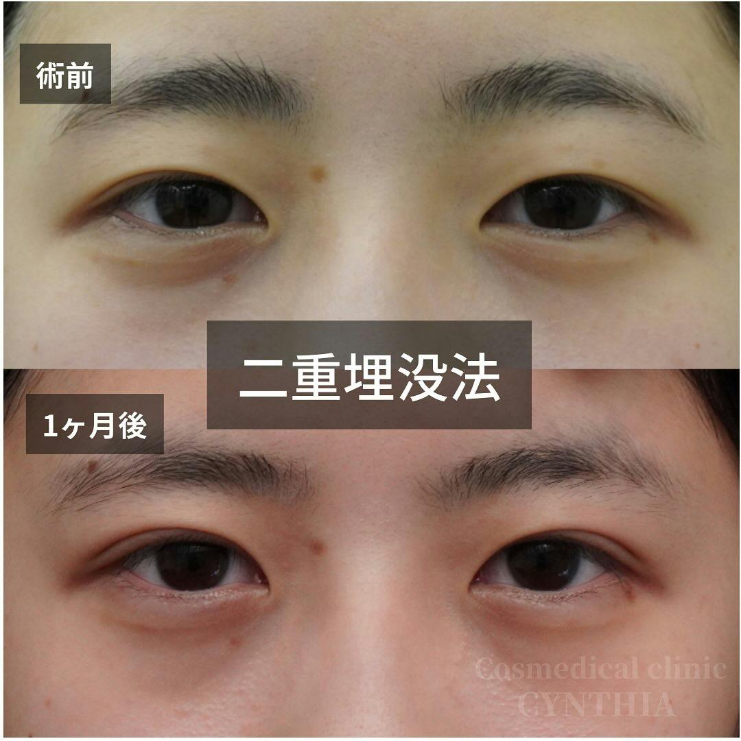 【10代女性・目元】二重埋没法_before_aftar