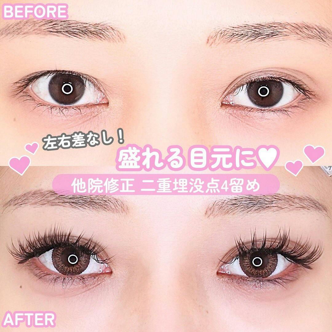 【女性・目元】他院修正 二重埋没点4留め_before_aftar