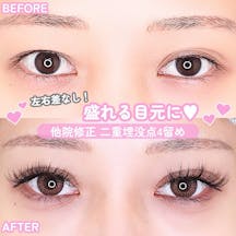 【女性・目元】他院修正 二重埋没点4留め_before_aftar