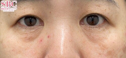 【50代女性・クマ】目の下の切らないクマ・たるみ（ふくらみ）取り ナチュラル脂肪注射コンデンスリッチ ナチュラル脂肪注射ナノリッチ_before