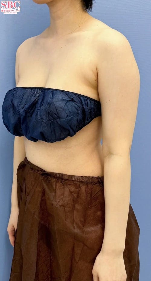 【30代女性・二の腕】根こそぎVASER脂肪吸引、Aquicell（アキーセル）脂肪吸引_before